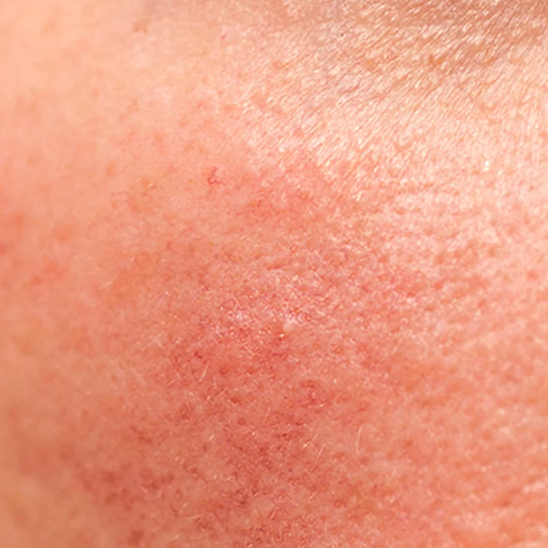 Rosacea