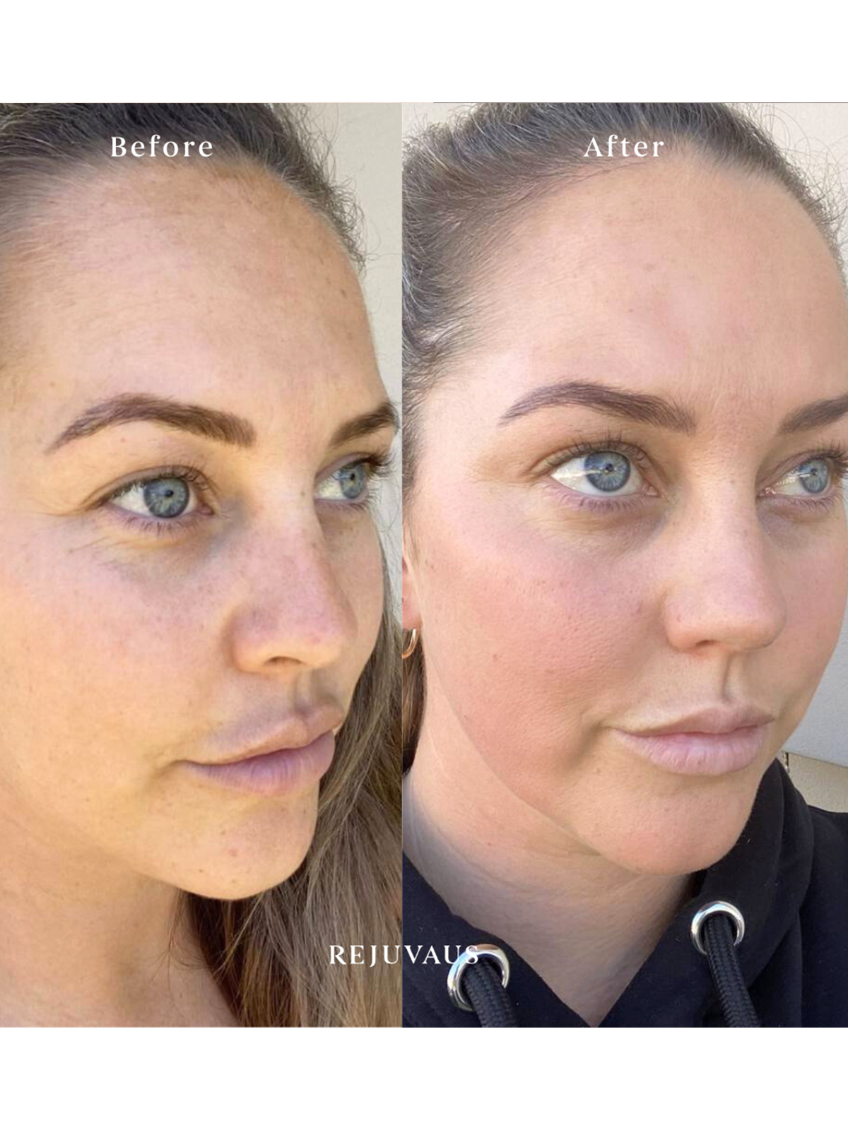 clarify serum before-after