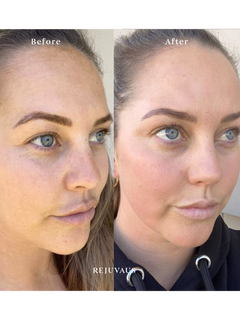 clarify serum before-after